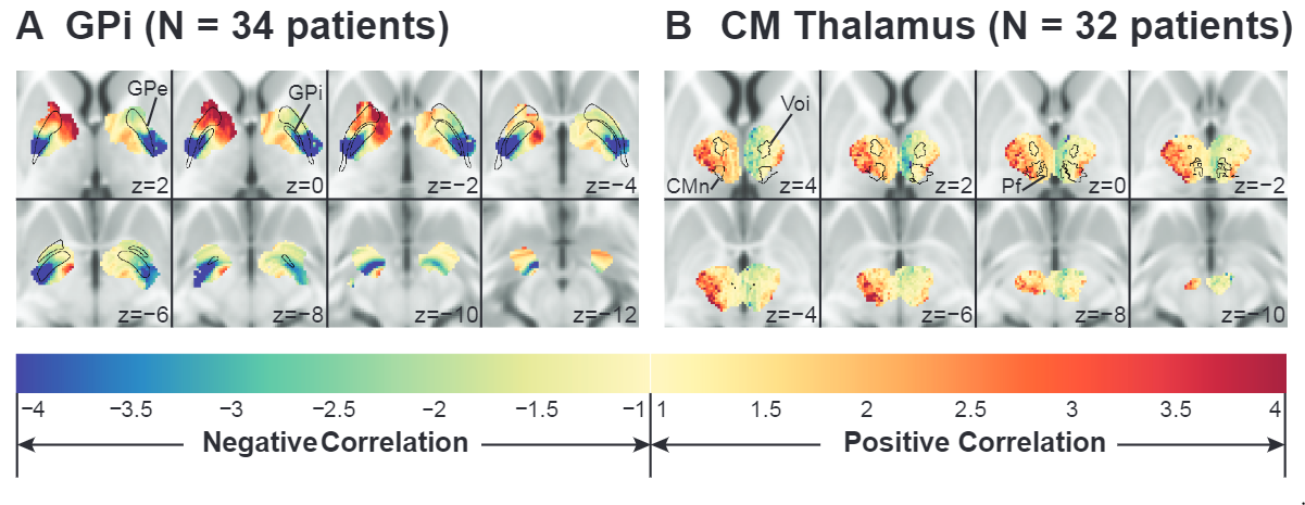 Parcellation of the total stimulation volume based on connectivity to networks correlated with improvement in tics. Patients implanted in GPi or CM thalamus. Cold colors denote higher connectivity to negatively correlated regions, and warm colors denote higher connectivity to positively correlated regions.